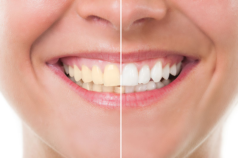 Teeth Whitening in San Bernardino